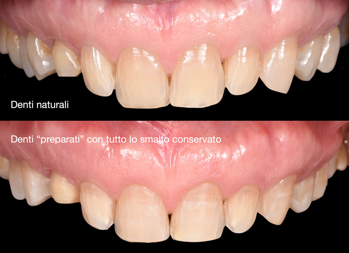 Faccette dentali preparazione e impronte pieroni - Studio dentistico Pieroni